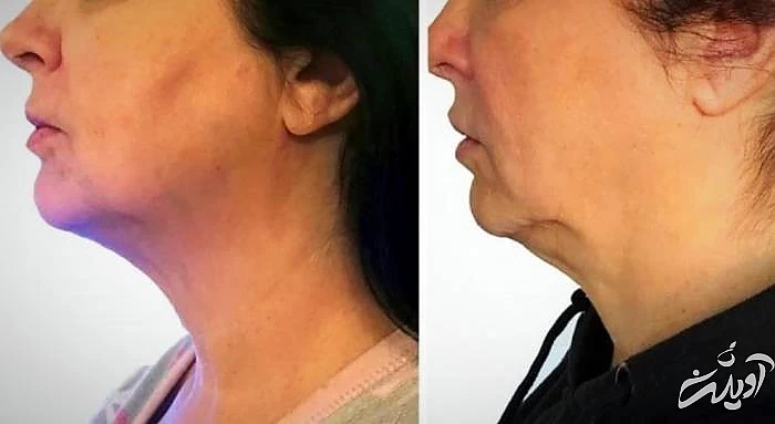 اندولیفت گردن